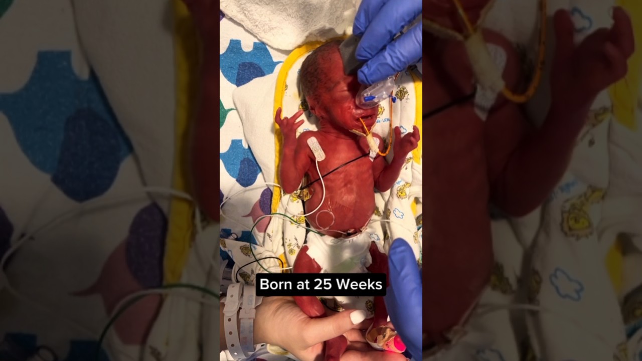 Born At 25 Weeks🥺 | He survived 💜#baby #cutebabies #mixedbabies #newbornbaby #fighter #USA #love
