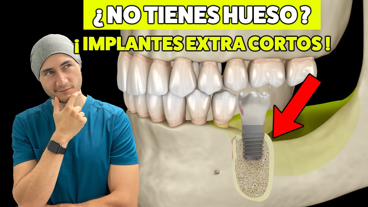 ¿No tienes hueso? Implantes dentales EXTRA CORTOS, ¡Podrían ser tu solución!