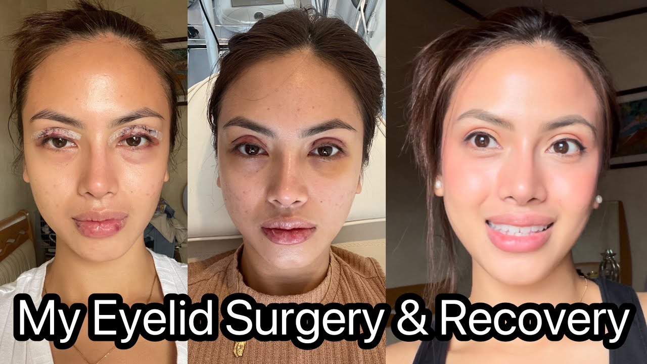 Верхняя блефаропластика (пластика век)