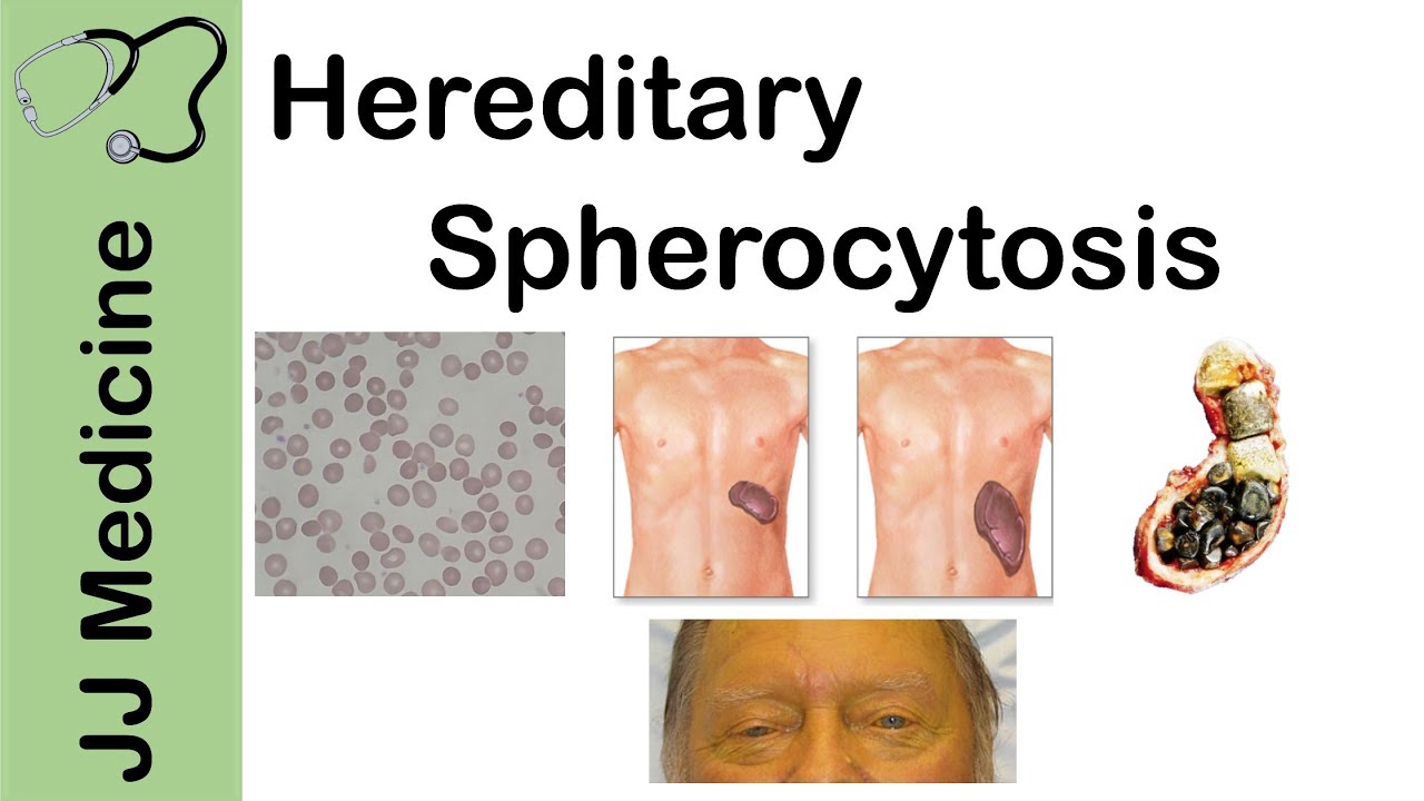Hereditary Spherocytosis | Pathophysiology, Symptoms, Diagnosis and Treatment