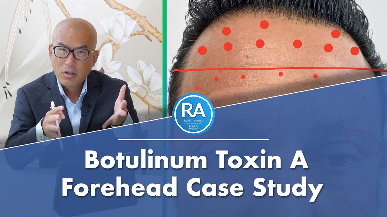 Botox Forehead on Man // Botulinum Toxin A Injections Case Study