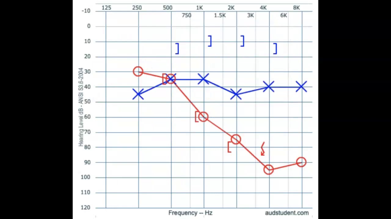 Audiogram interpretation