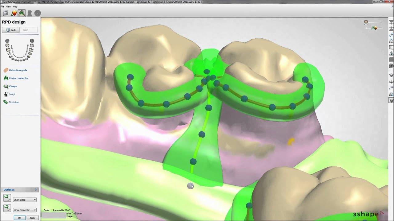 Dental System™ 2012 - Removable Partial Design