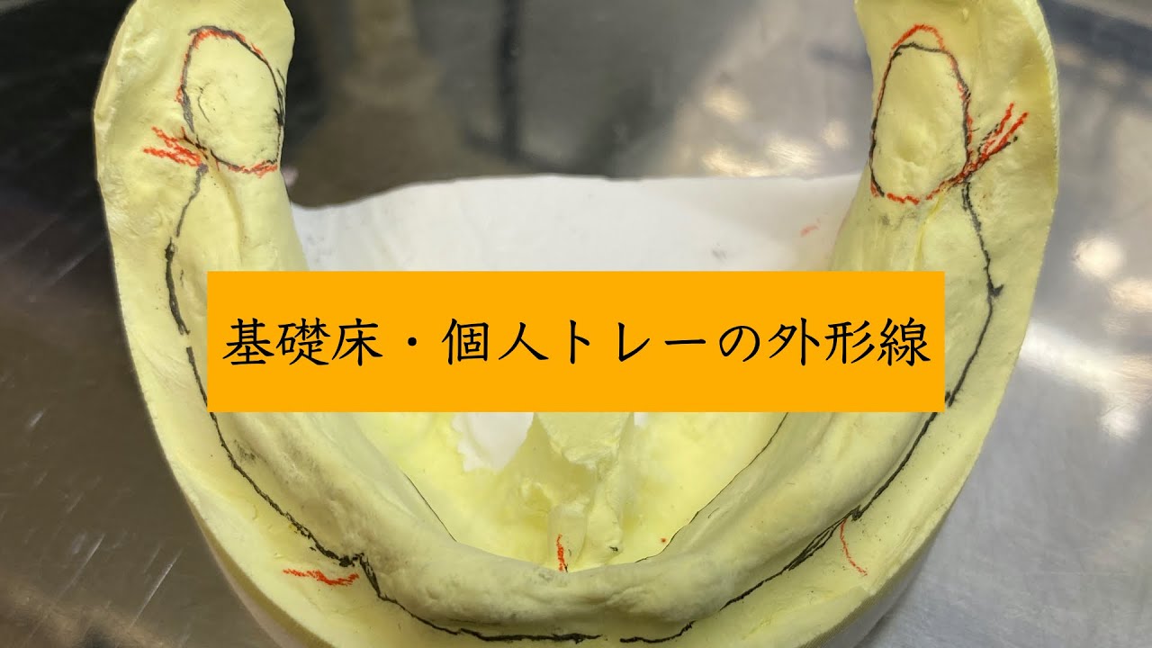 歯科医師向け【下顎全部床義歯個人トレーアウトライン】