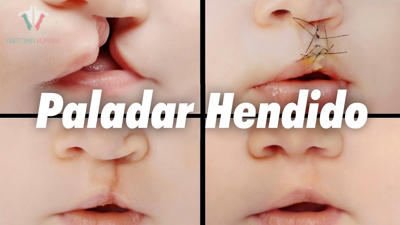 Por qué hay paladar hendido: Habla la ciencia