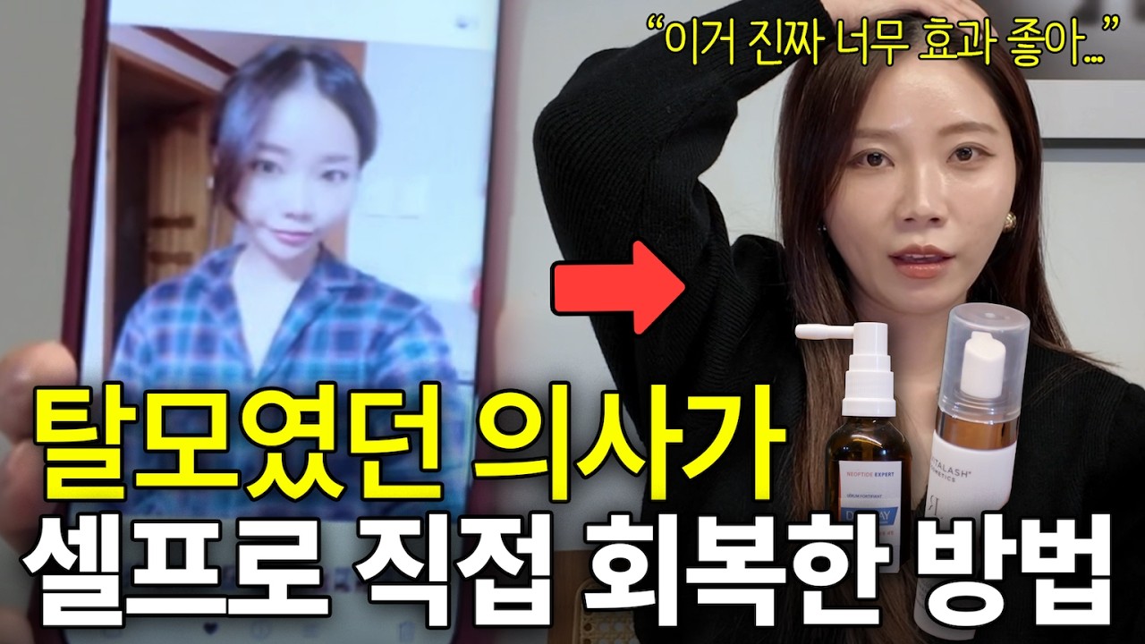 정수리 휑한 분들에게 머리나는 약 추천