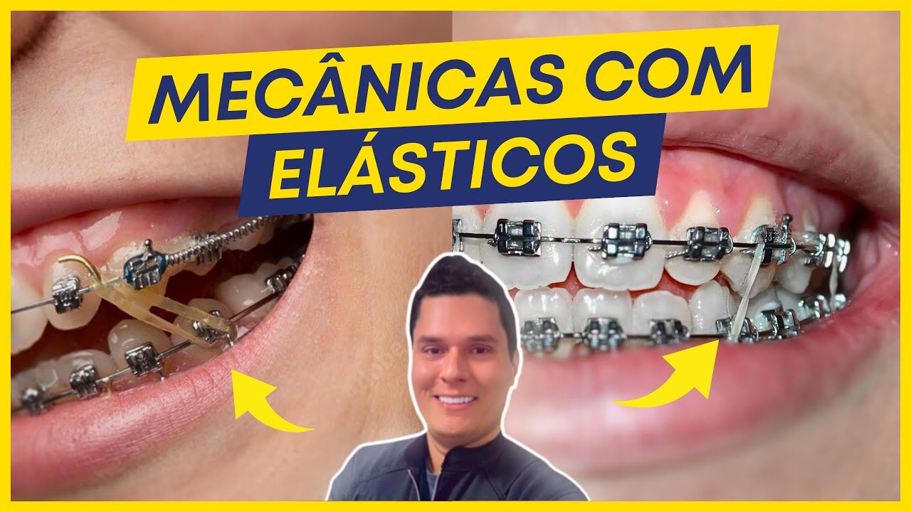 ELÁSTICOS ORTODÔNTICOS: PRINCIPAIS INDICAÇÕES E EFEITOS NOS DENTES!