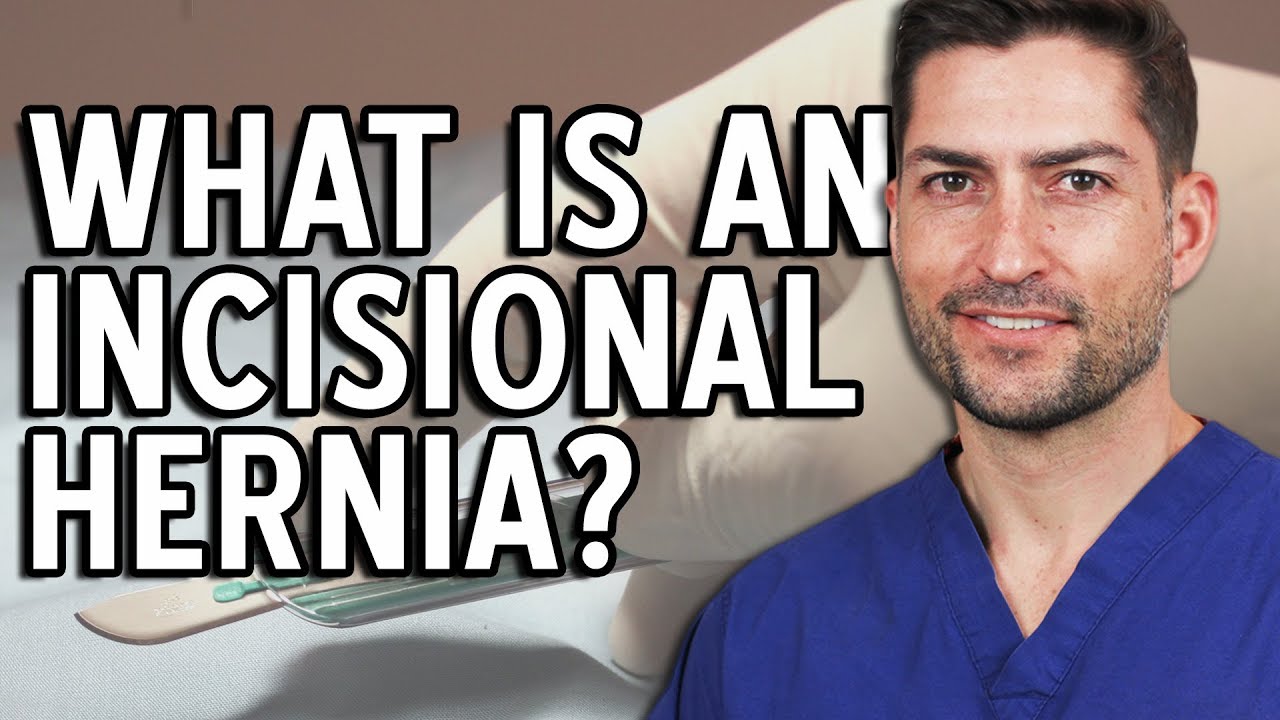 Incisional Hernia - What It Is and Why It Happens