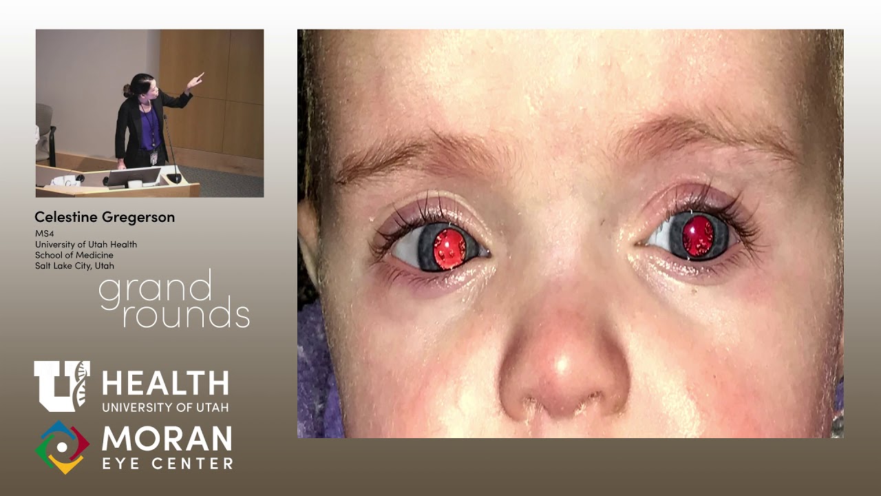 Curiosity Killed the Cataracts: A Curious Case of Congenital Cataracts