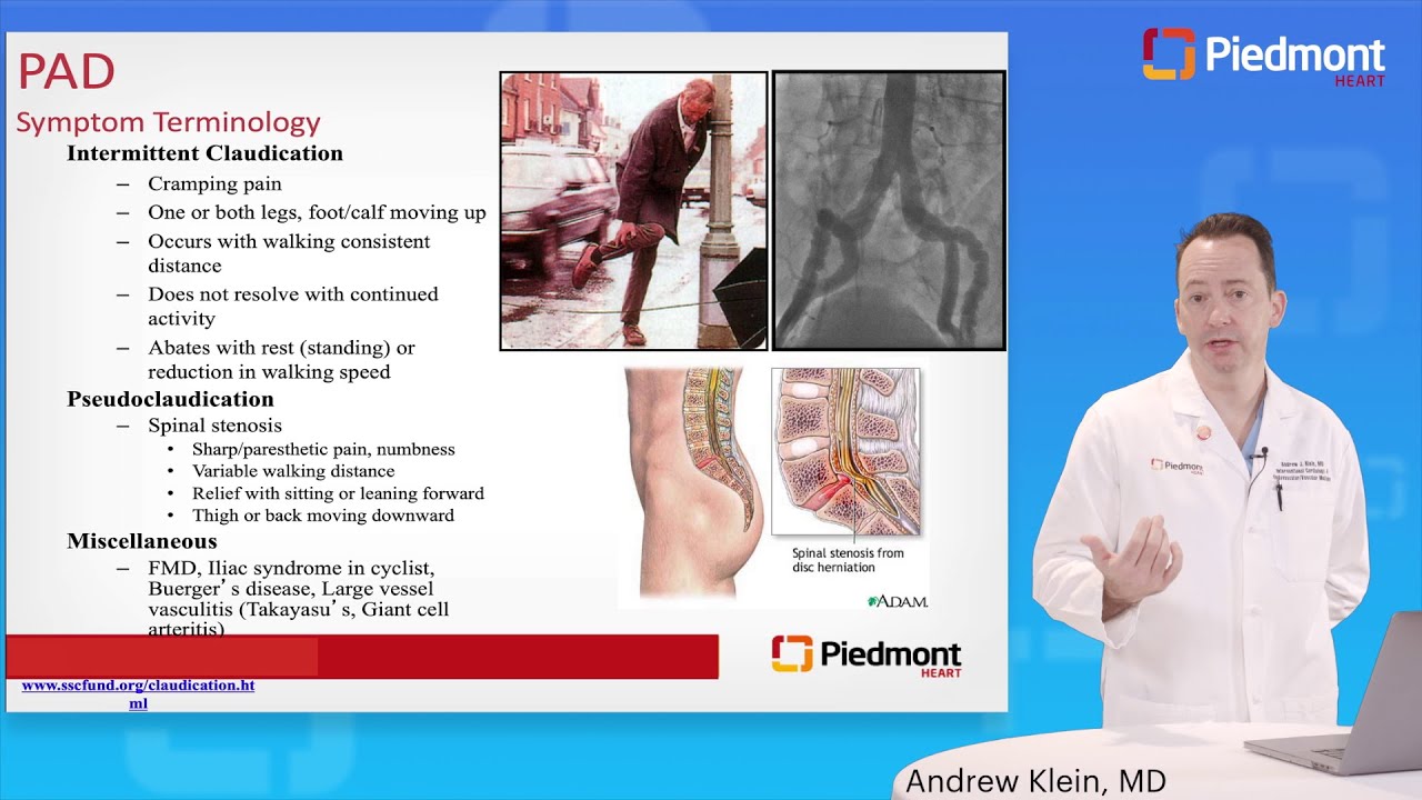 Peripheral Arterial Disease for the Internist
