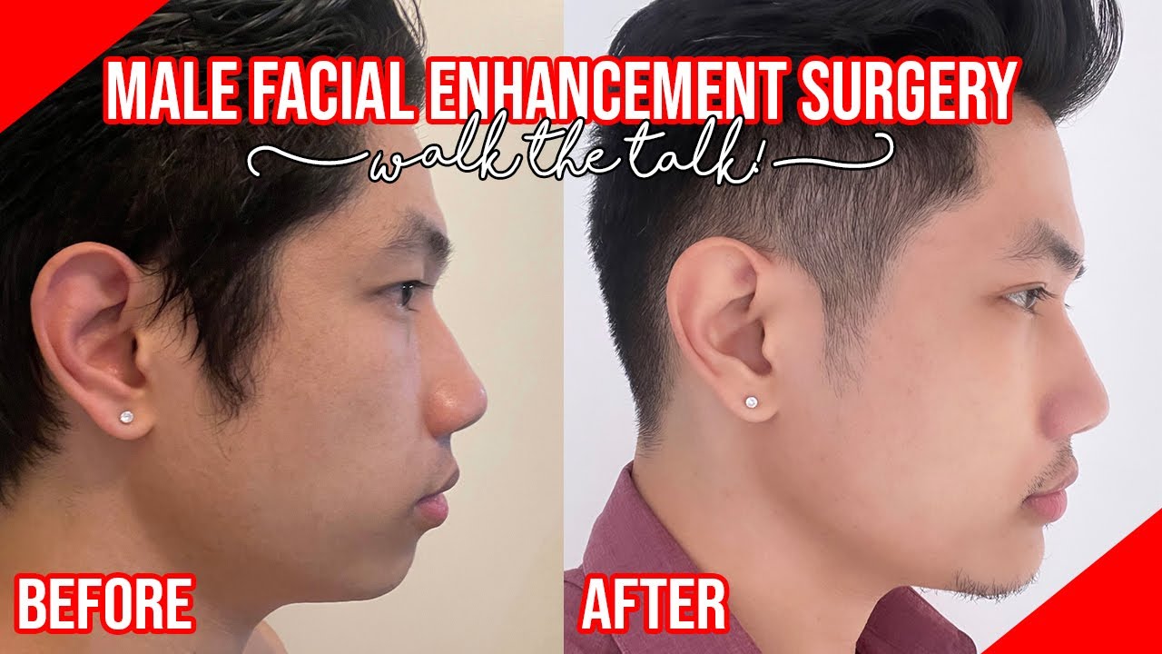 Double eyelid surgery & Chin augmentation | COSMETIC SURGERY PHILIPPINES