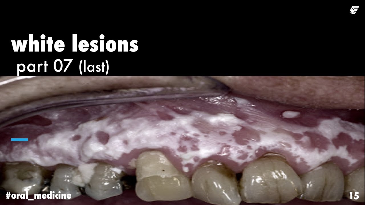 white lesions || lichen planus 2 || oral medicine _ عزت شومان