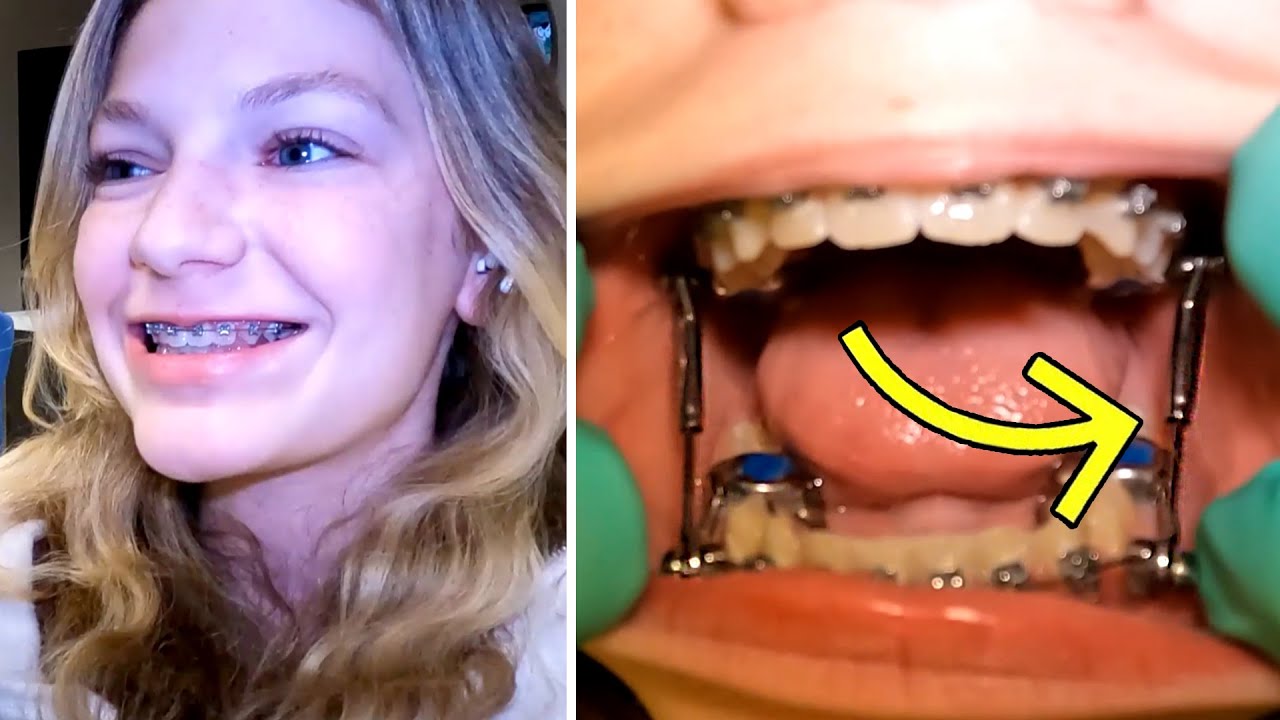 Getting a HERBST APPLIANCE for an overjet | McKinney Orthodontist