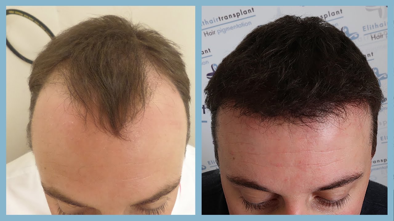 Hair transplant Turkey  -  costs and experiences -  The TV report