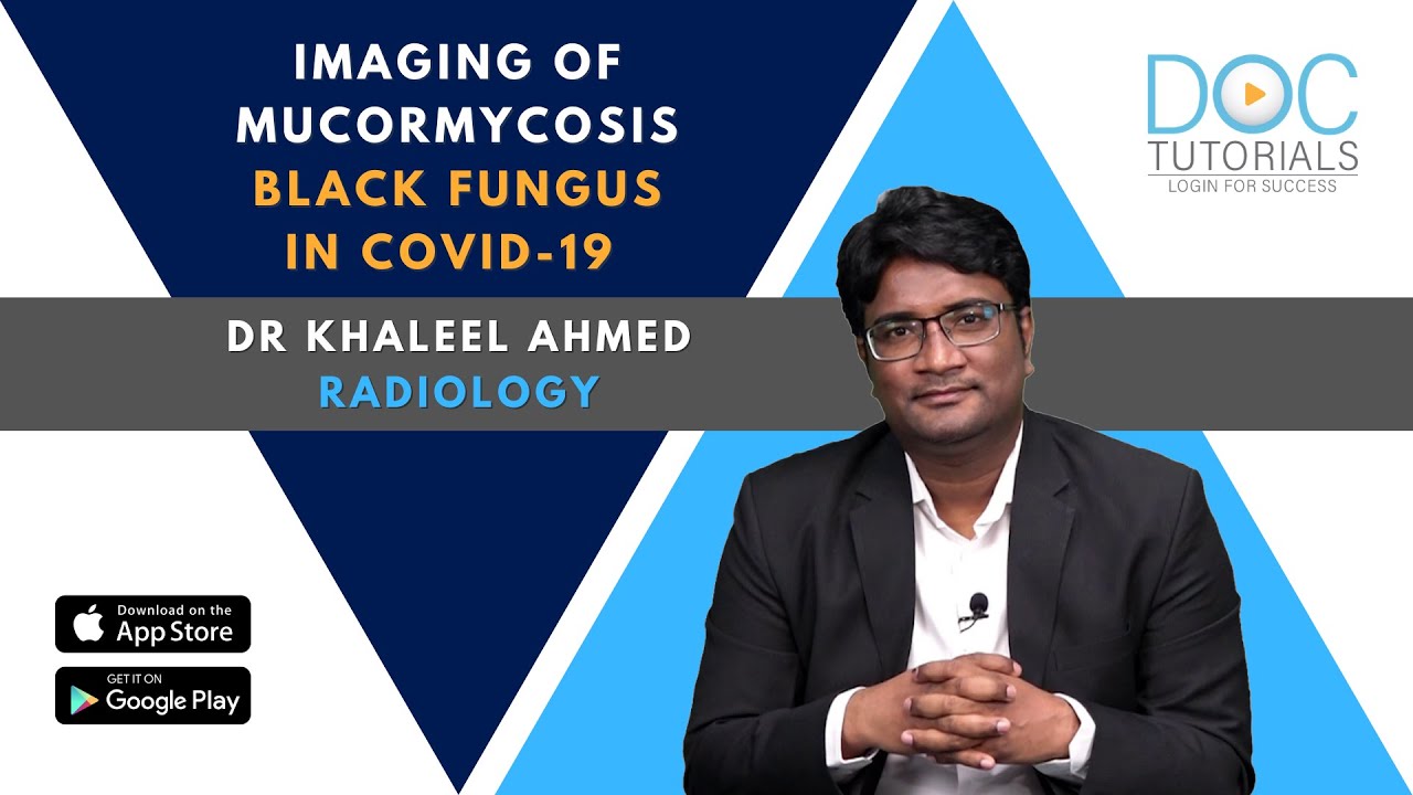 Black Fungus in COVID19 | Dr. Khaleel Ahmed on Imaging Findings Of Mucormycosis | DocTutorials