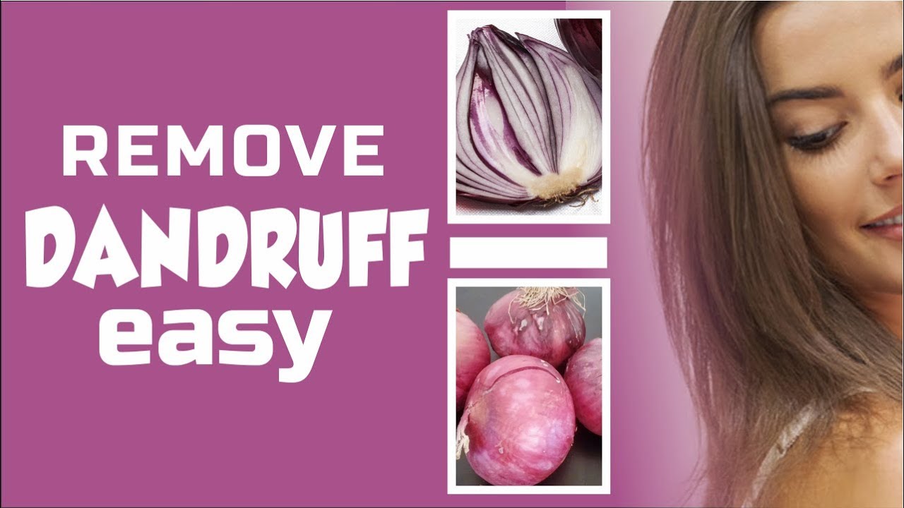 Easy Way to Get Rid of Dandruff with ONION JUICE