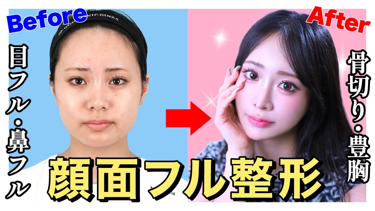 【密着】顔面フル整形に密着！ダウンタイムから完成まで【劇的変化】