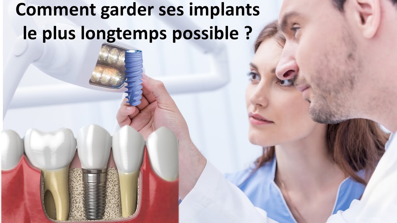Contr&ocirc;le et Entretien de l'implant dentaire - Comment garder ses implants le plus longtemps possible