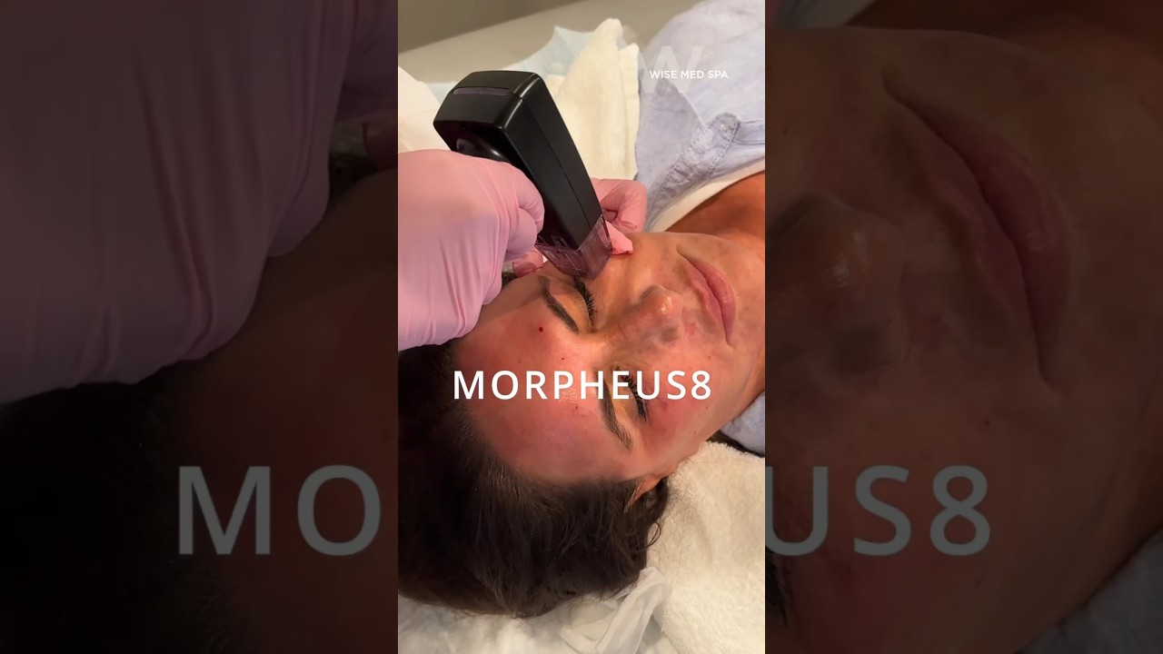 Morpheus8 &mdash; это отличный нехирургический способ подтянуть кожу под глазами и уменьшить мешки под ...
