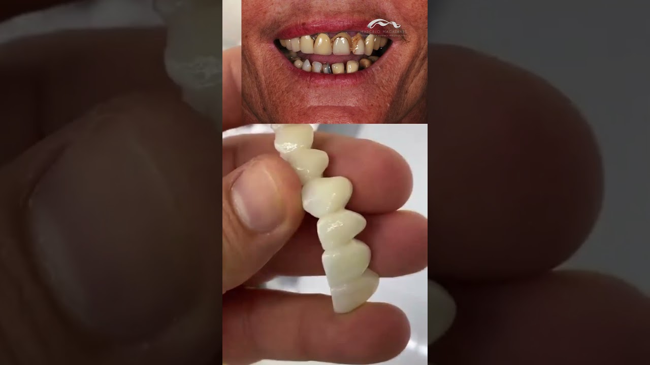 Ponte fixa * implantes dentarios * Dr Marcelo Magalhães * Dentista em Fortaleza