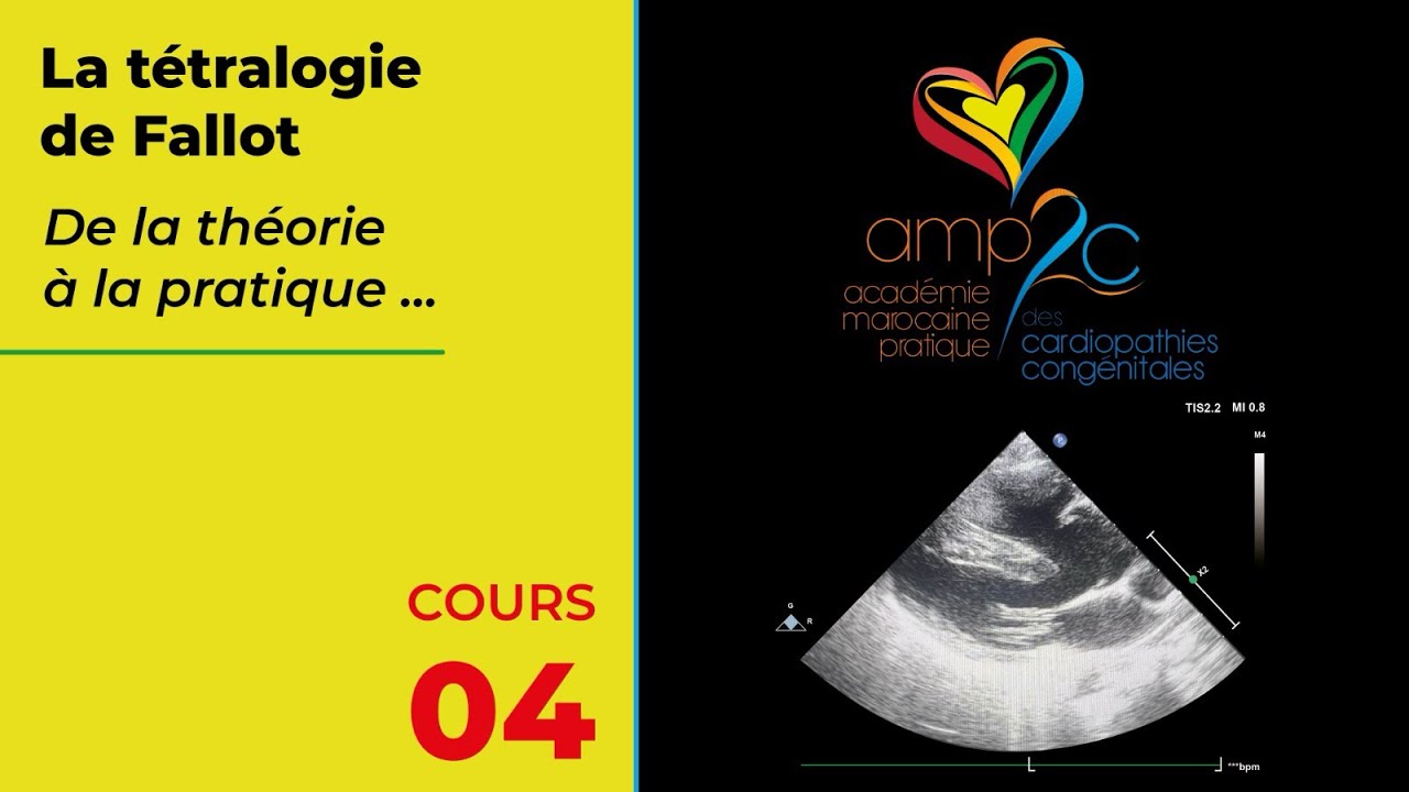 Cours AMP2C : La tétralogie de Fallot ( S. MOUGHIL , S. Chraibi)