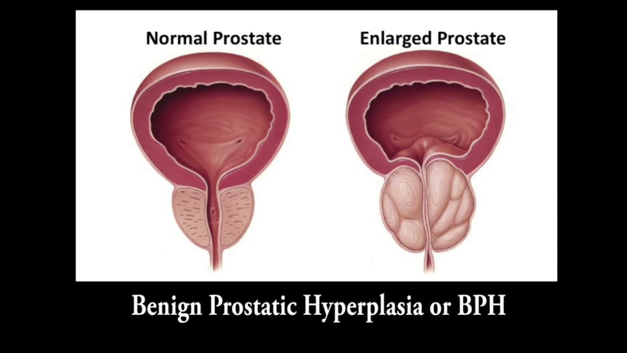 Dr. Jared Moss: Greenlight Laser for BPH