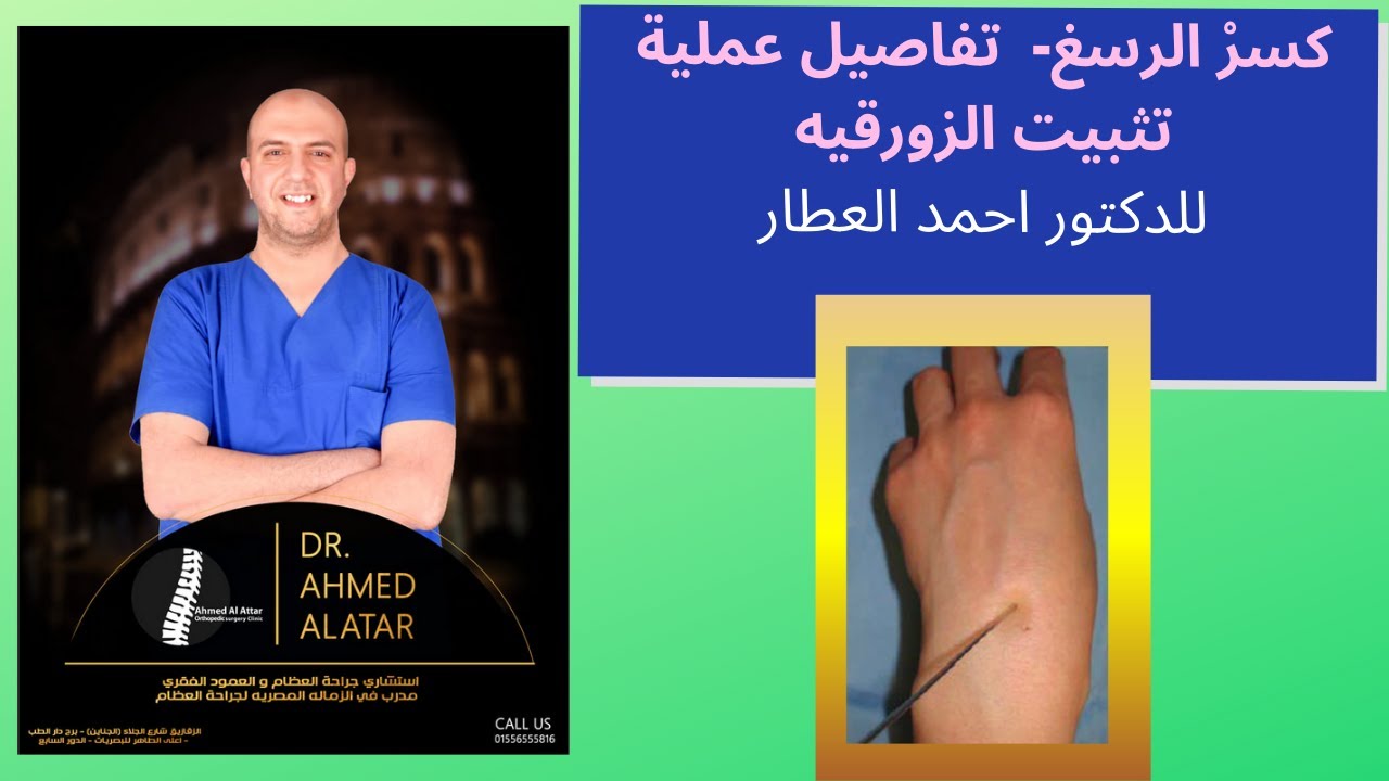 كسرْ الرسغ - تفاصيل عملية تثبيت الزورقيه للدكتور احمد العطار