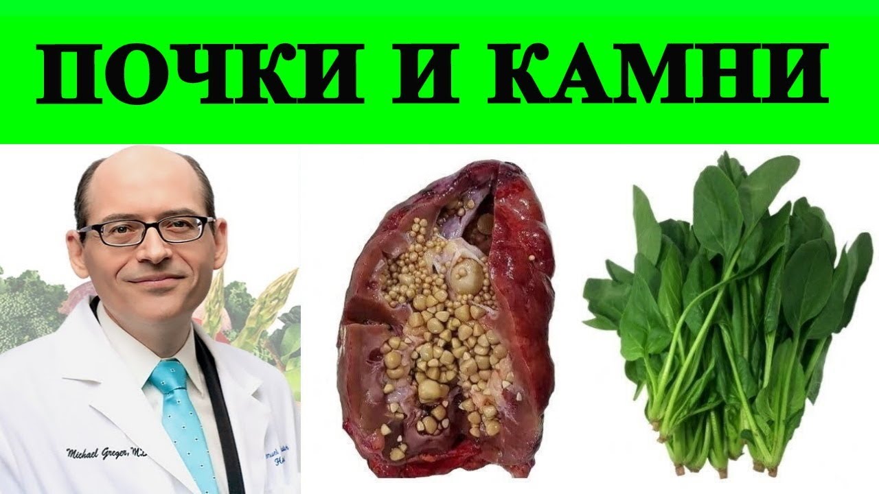 🔴 Камни в Почках и Шпинат, не ешьте слишком много! - доктор Майкл Грегер