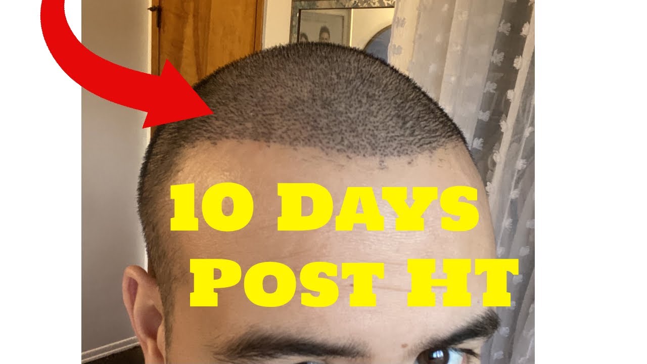 10 Days After My FUE Hair Transplant in Turkey | 4,550 Grafts | Cinik Clinic |