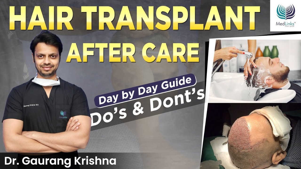 Post Hair Transplant Care Day-by-Day Guide | Do's and Don'ts Just After Hair Transplant | Medlinks