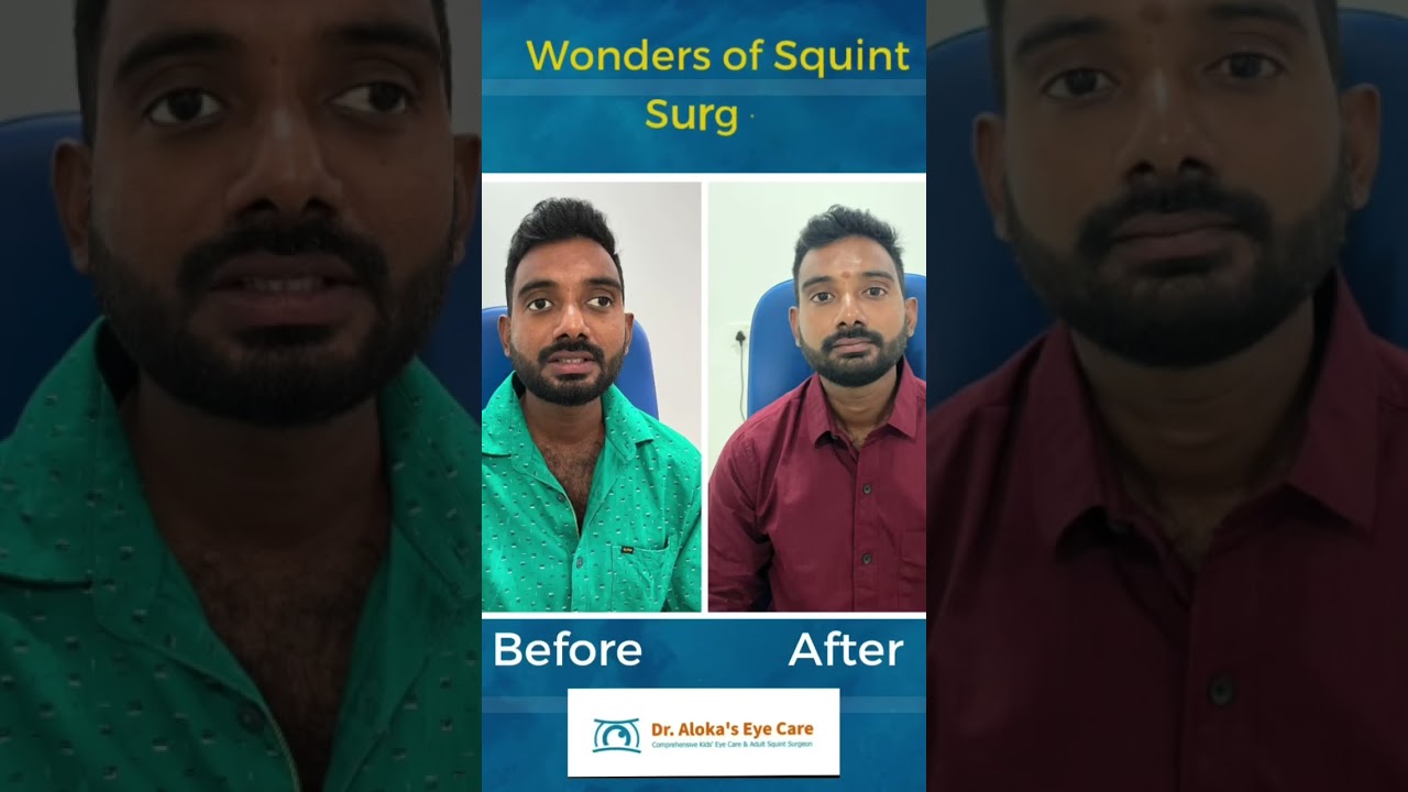 Better Vision, Depth Perception, Looks and Elevated confidence That&rsquo;s the Magic of Squint surgery