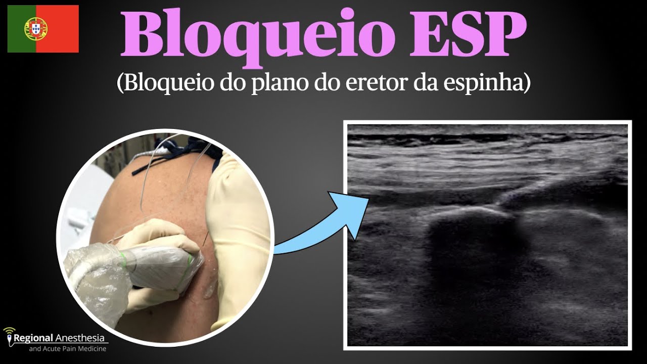 Bloqueio ESP (bloqueio do plano do eretor da espinha)