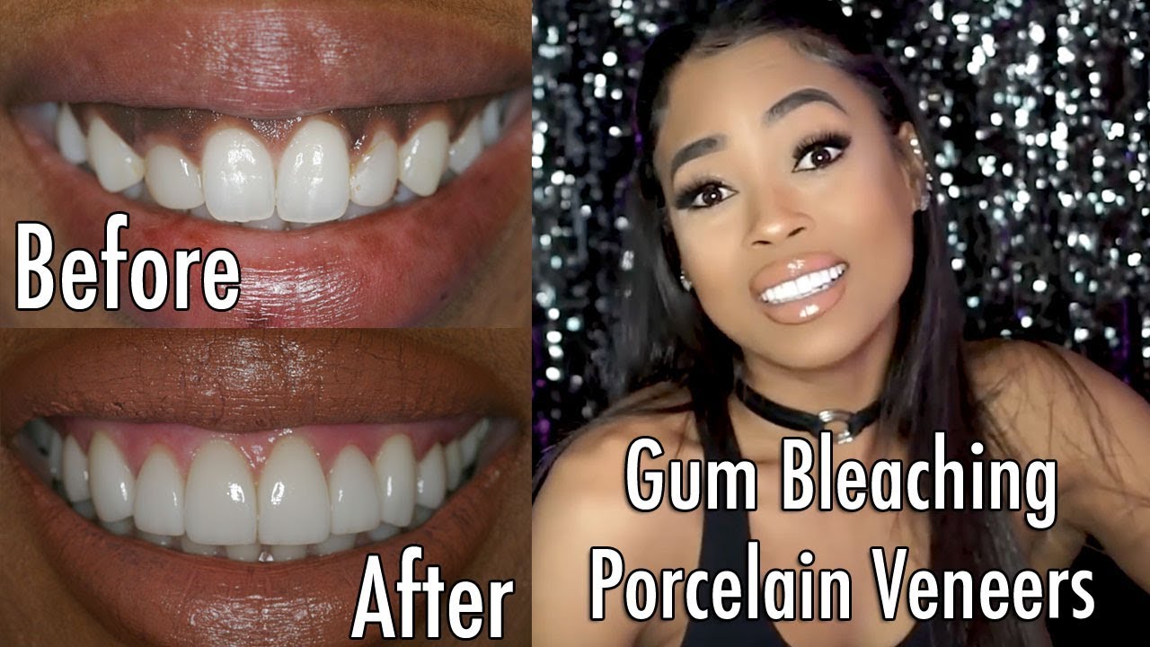 Stunning Porcelain Veneers and Gum Bleaching at Los Angeles’ Best Dentist - Southland Dental Care!