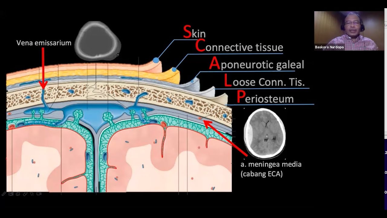 Membaca CT SCAN kepala ( record zoom  20-07-2020 jam 7.02 wib)