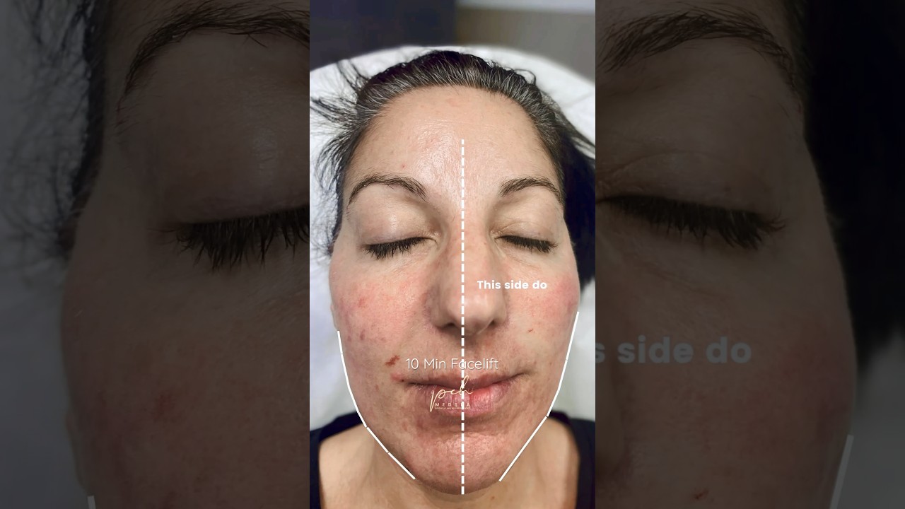 Watch this 10 minutes facelift, PDO Thread Lift, PCH MedSpa, Orange County