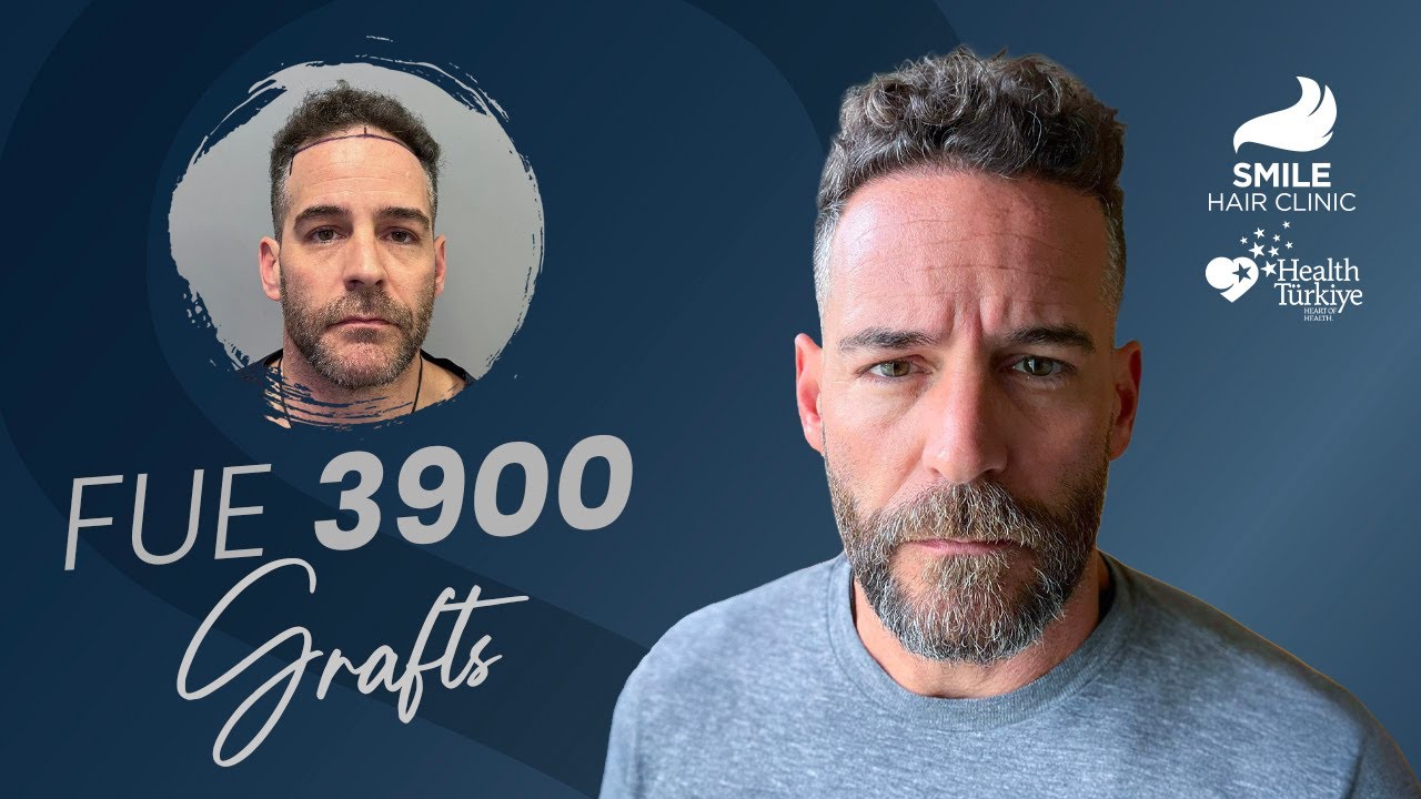 Before & After: 3900 Grafts FUE Journey | 3, 6 & 9-Month