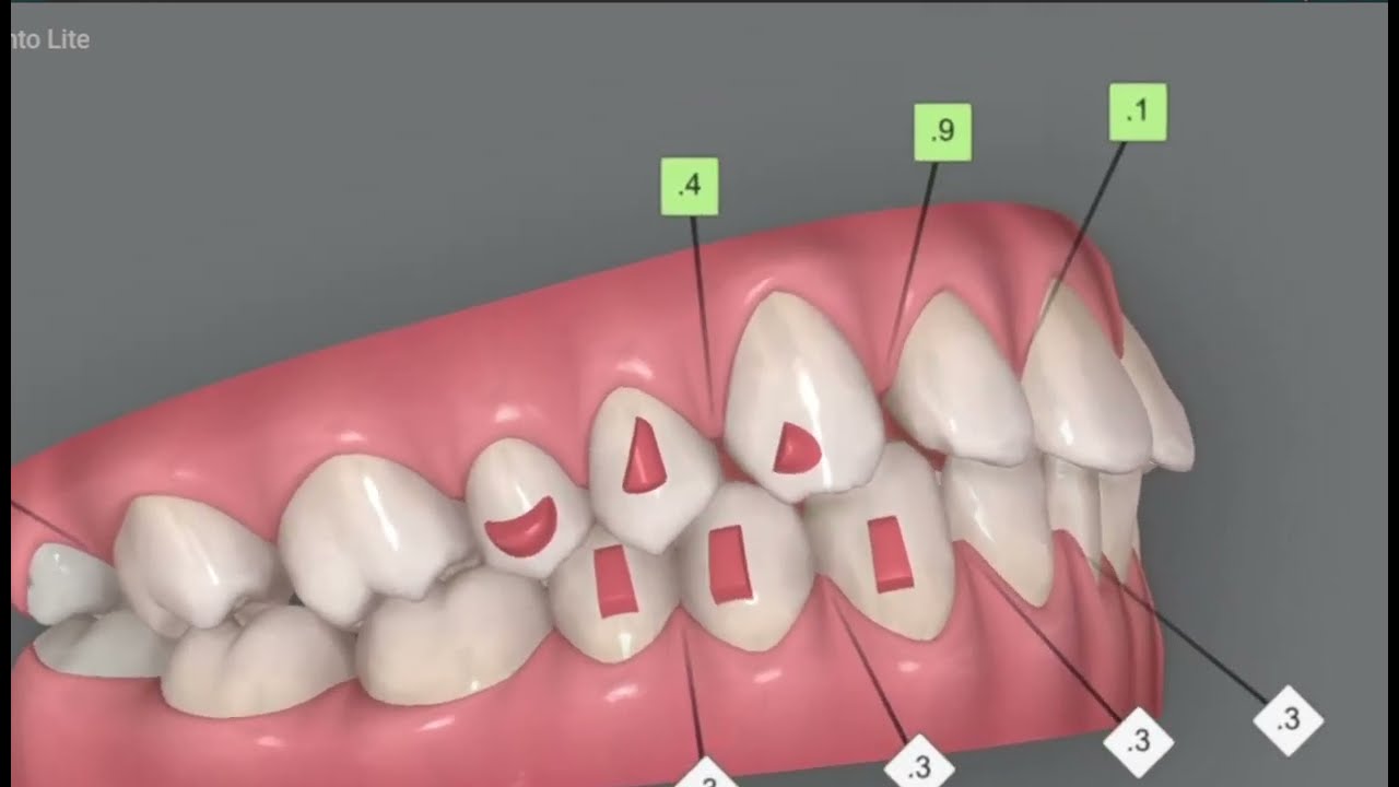 Simple alignment of teeth. Invisalign Lite clincheck simulation
