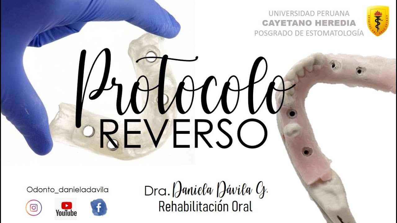 Protocolo reverso en prótesis sobre implantes (Explicación paso a paso)