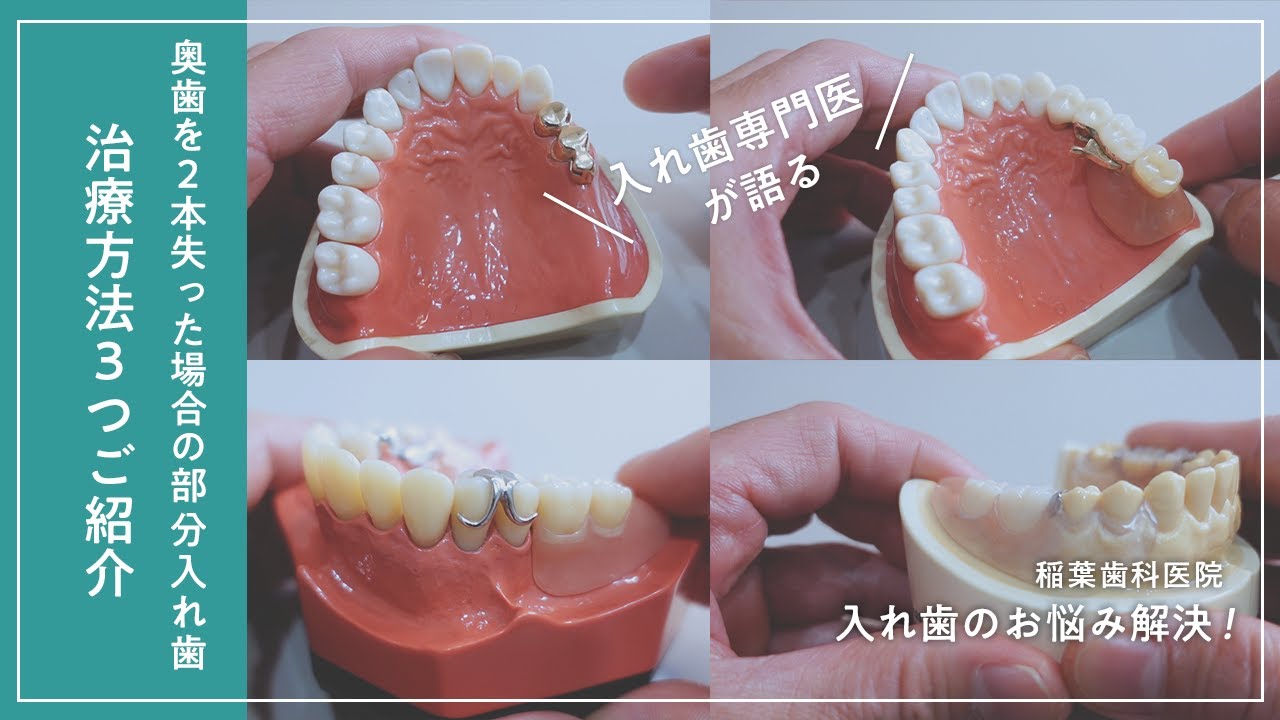 「奥歯を失った場合の部分入れ歯」治療法3つをご紹介