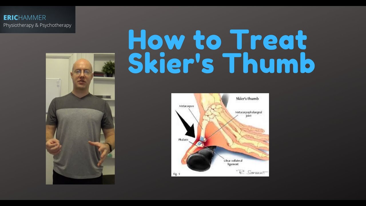 How to Treat Skier's Thumb