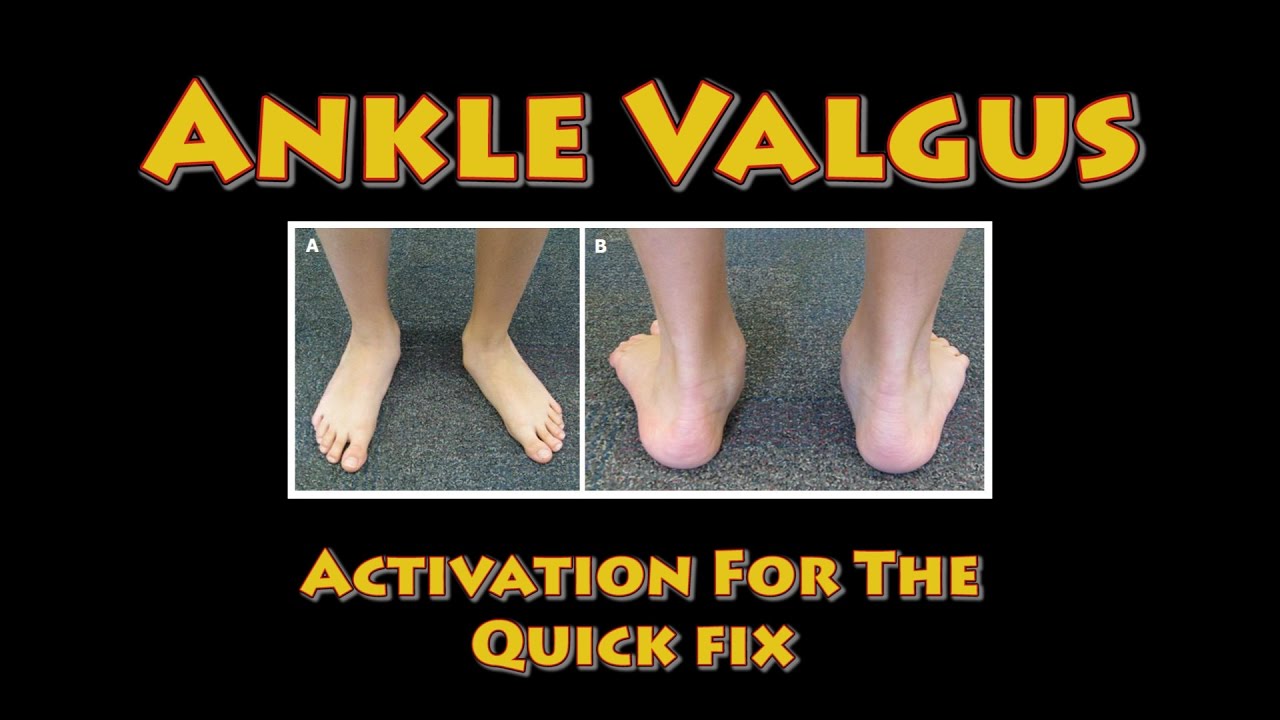 Ankle Valgus Correction