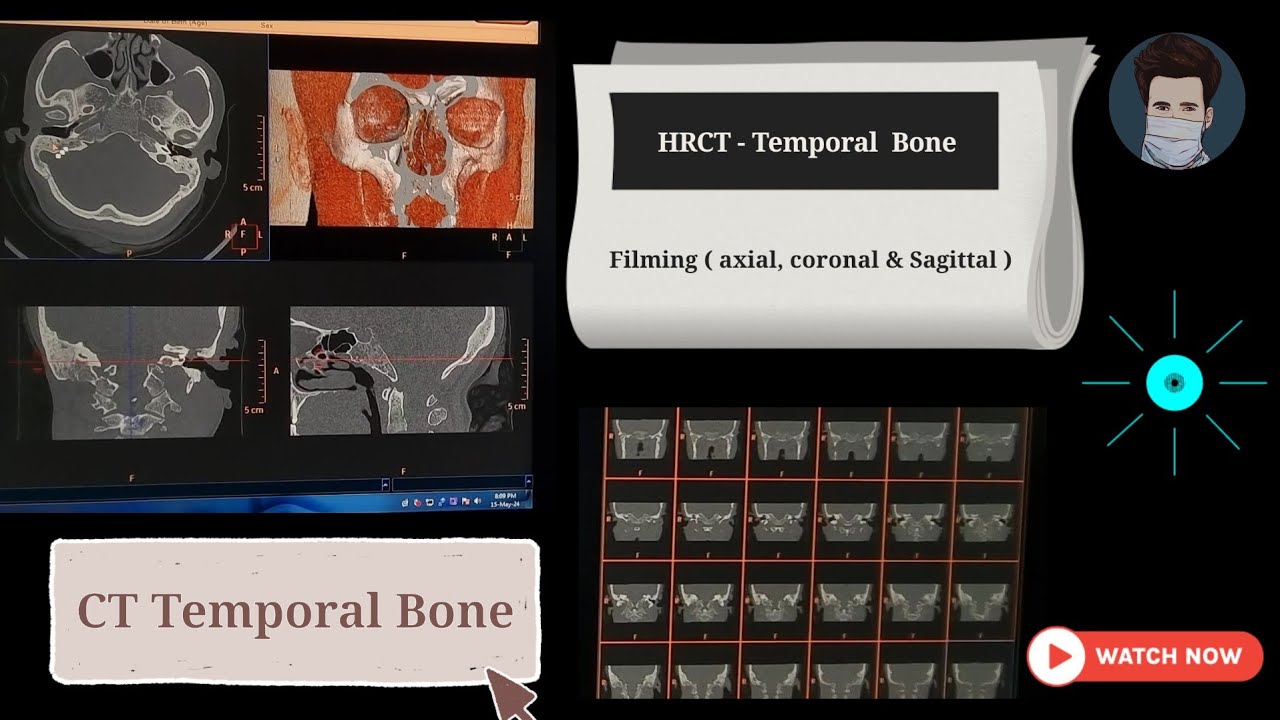Hrct / Ncct Temporal bone filming | Axial, Coronal & Sagittal| By Anis Qureshi