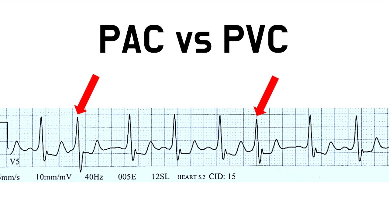 19강 - PAC vs PVC, 이 차이 하나면 끝 (김선생의 실전 심전도 20강)