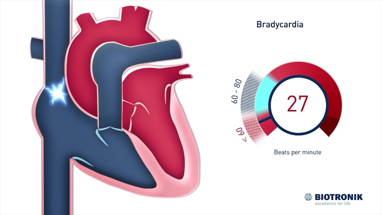 Mikä on normaali vs. hidas syke? | Medical Animation