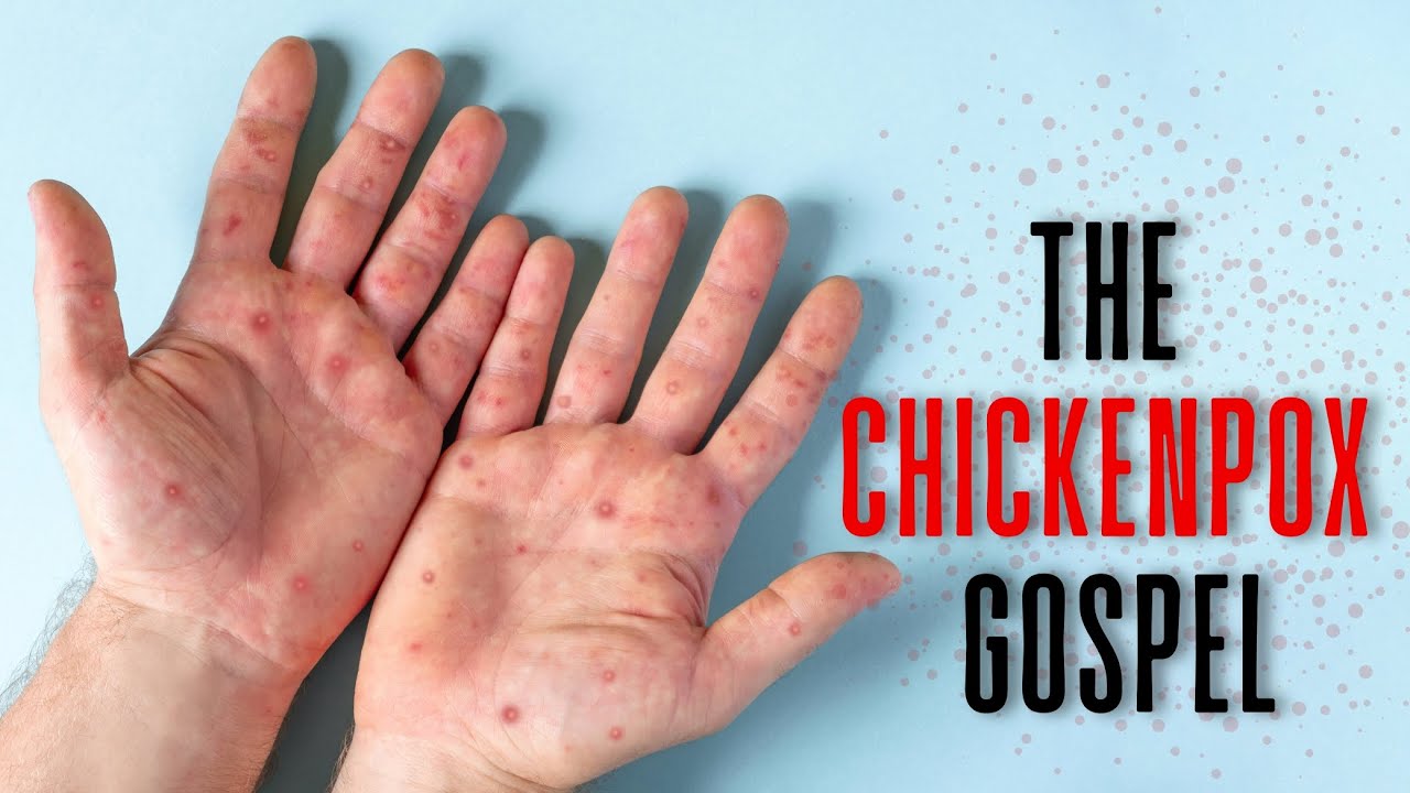 Fireside Friday: The Chickenpox Gospel