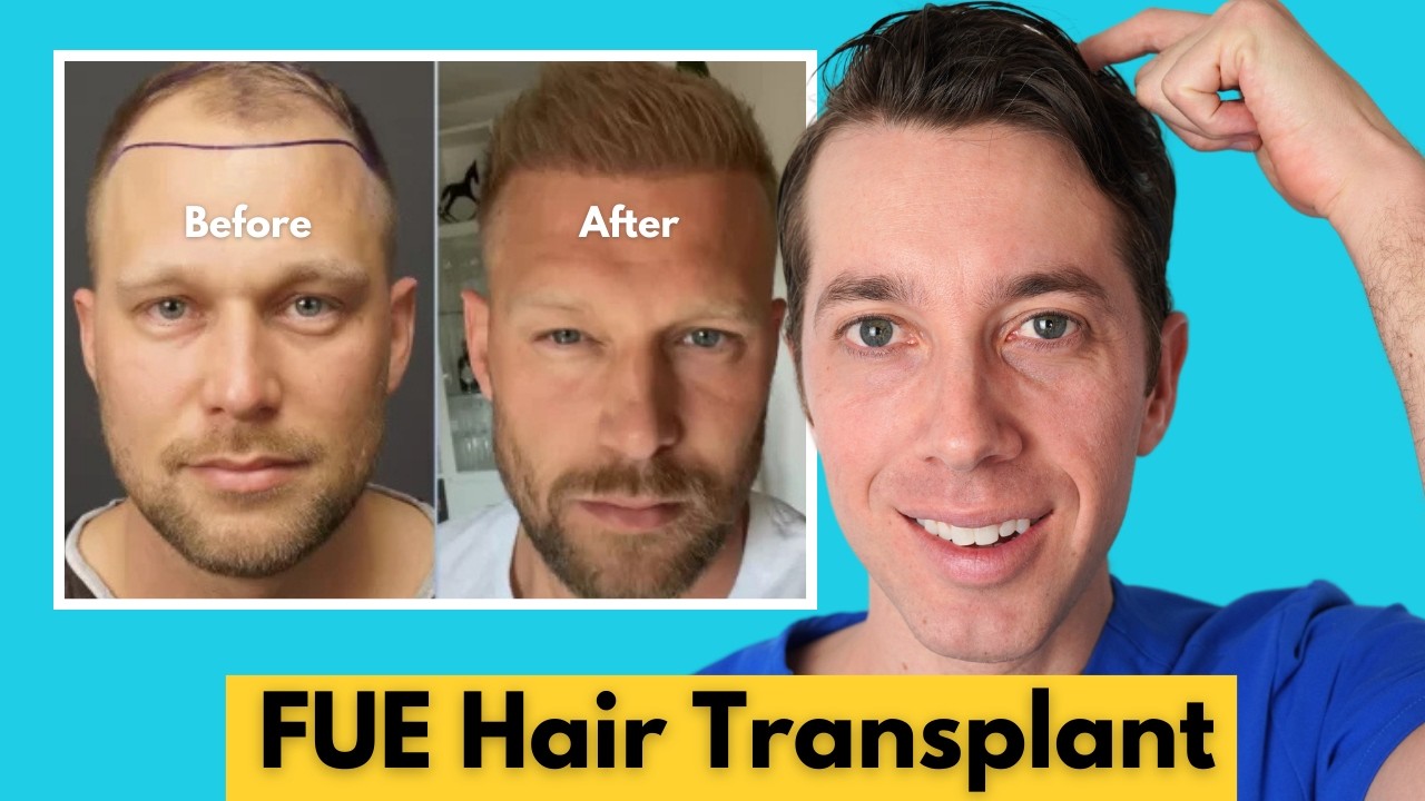 Is FUE Hair Transplant Worth It?