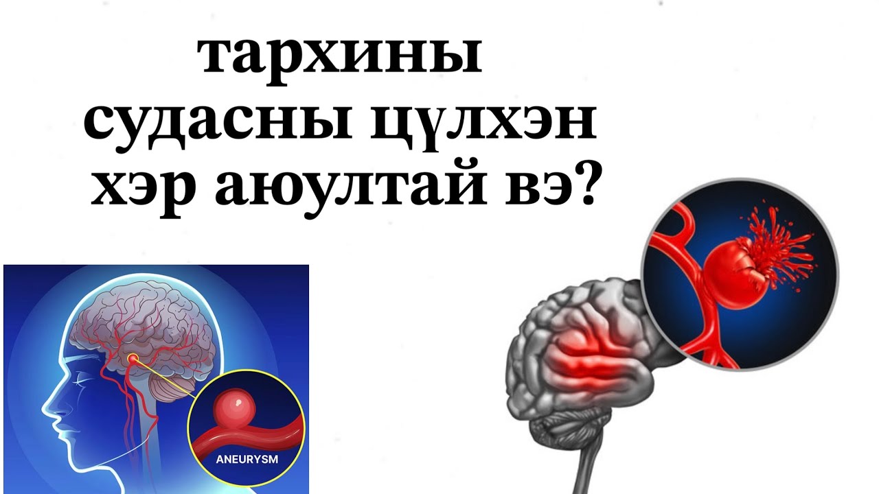 тархины судасны цүлхэн ямар хүмүүст их үүсдэг вэ?