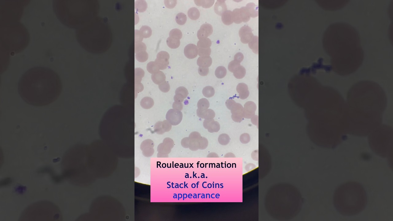 Rouleaux formation. #foryou #medtech #medtechstudent #fyp #rouleaux #shorts