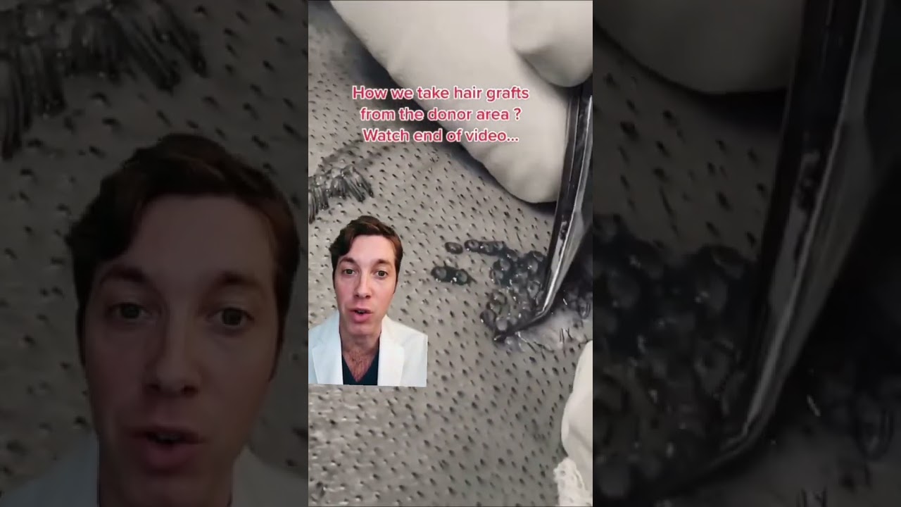 Come viene eseguito un trapianto di capelli FUE