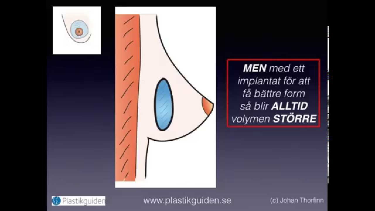 Br&ouml;stlyft med eller utan implantat
